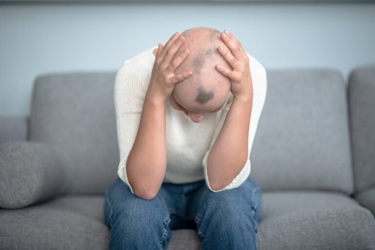 Alopecia: conheça doença que causa queda de cabelo feminina