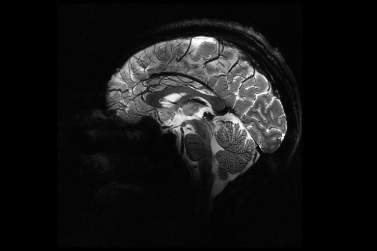 Entenda caso das 5 enfermeiras com tumor cerebral que trabalham juntas Entenda caso das 5 enfermeiras com tumor cerebral que trabalham juntas