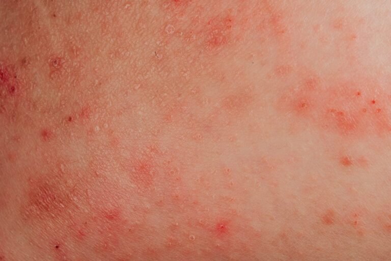 Alergia à água: condição real ou desculpa para não tomar banho? Alergia à água: condição real ou desculpa para não tomar banho?