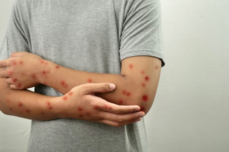 “A mpox não acabou e ainda exige vigilância constante”, diz médica