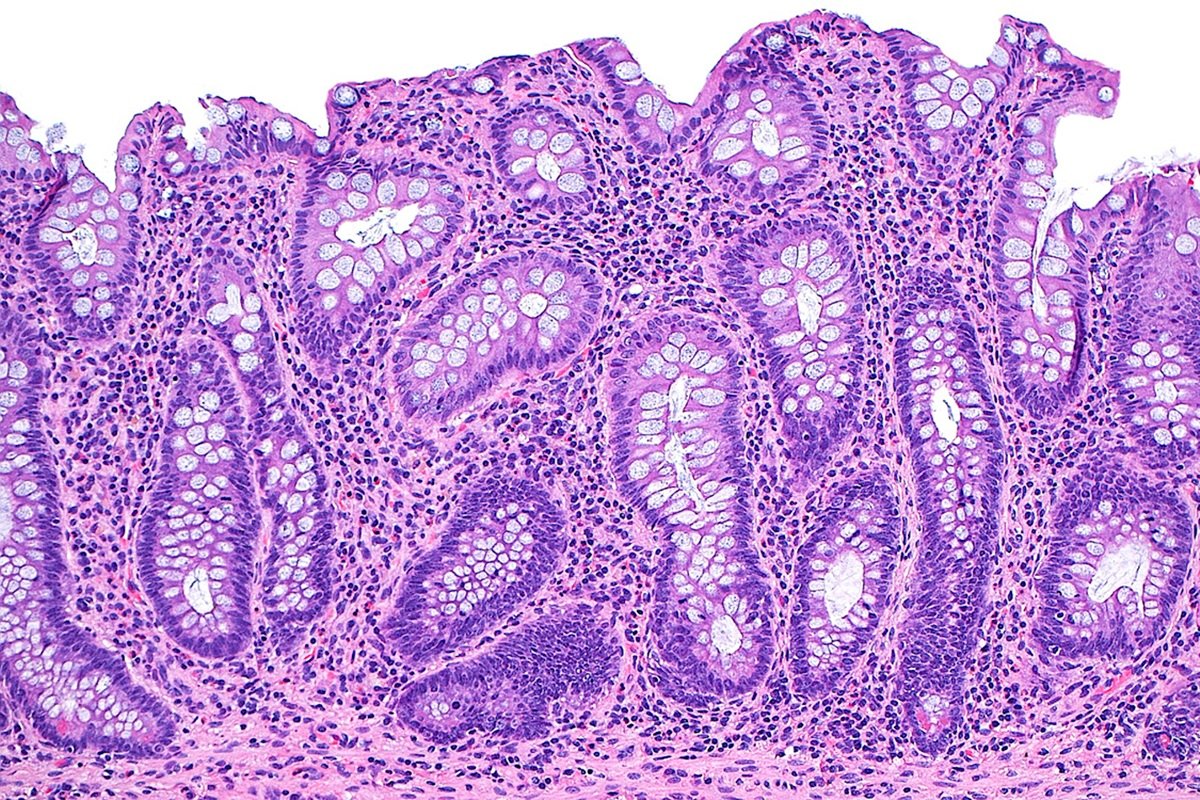 Doenças inflamatórias intestinais não são mais raras e exigem atenção