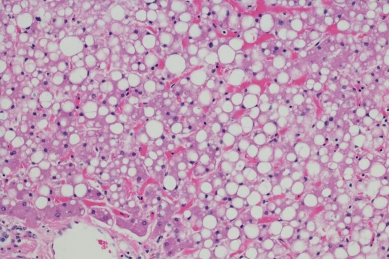 Gordura no fígado: saiba quais são os sintomas da esteatose hepática