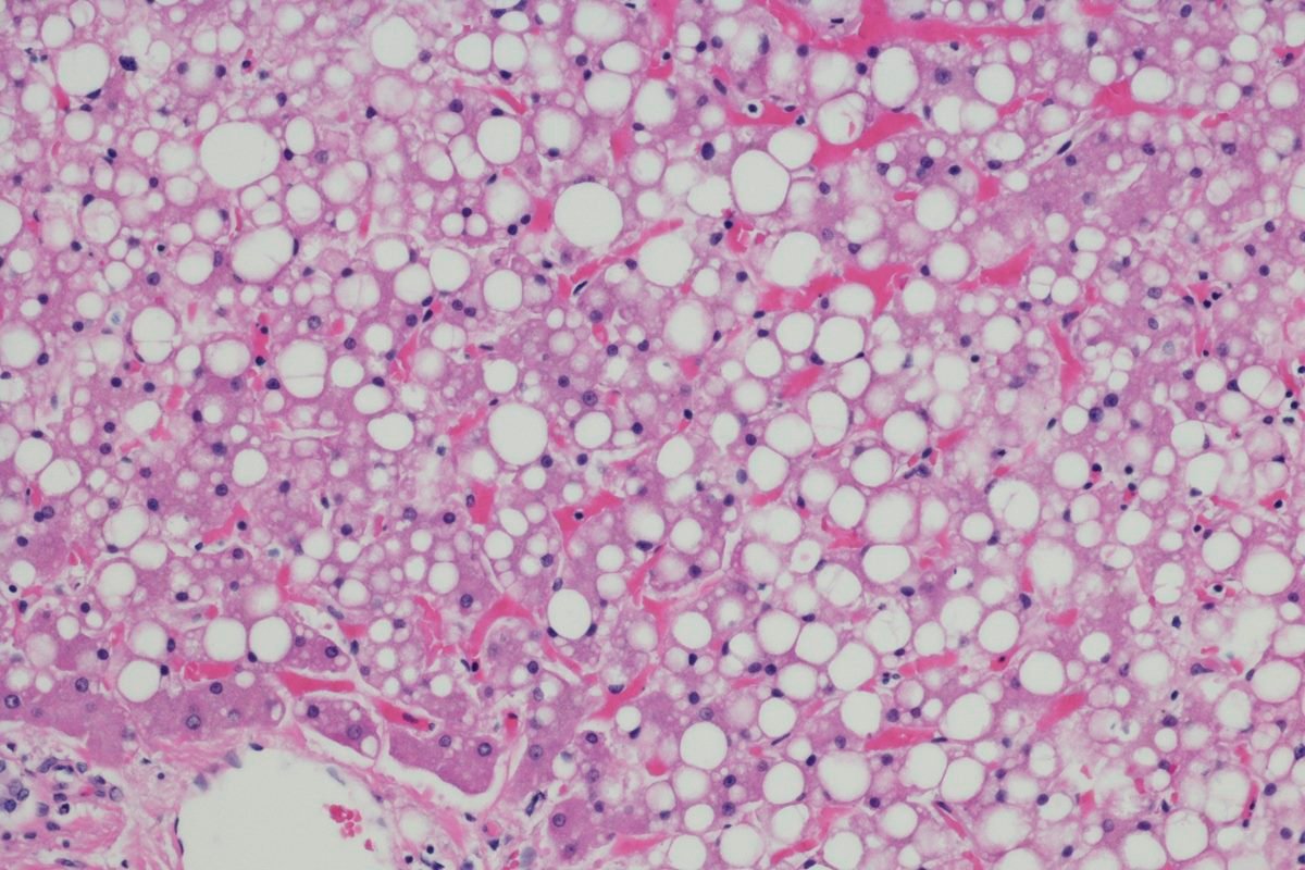 Gordura no fígado: saiba quais são os sintomas da esteatose hepática