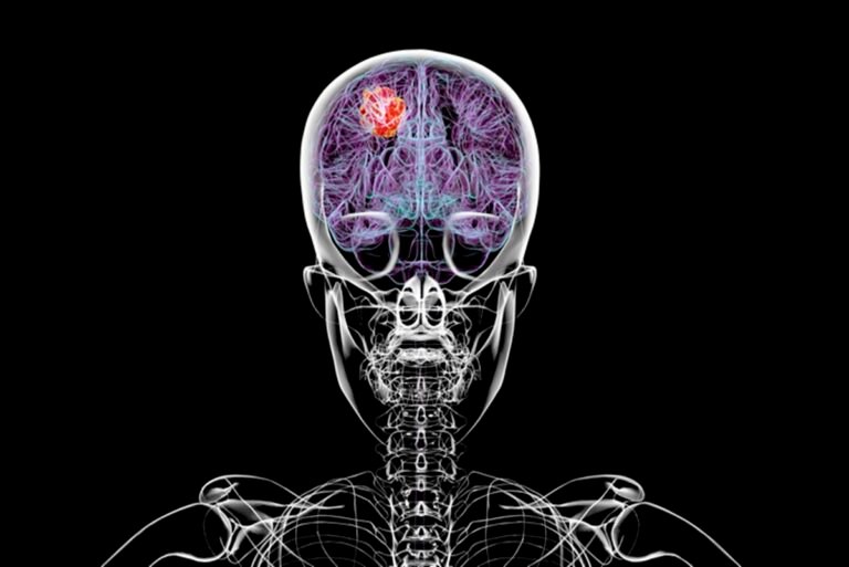 câncer cerebral grave corrói o crânio, diz estudo