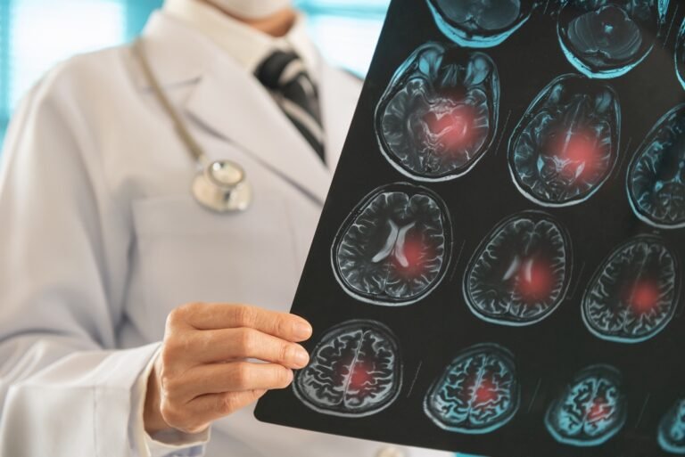 Células-tronco podem ajudar na recuperação do cérebro após AVC