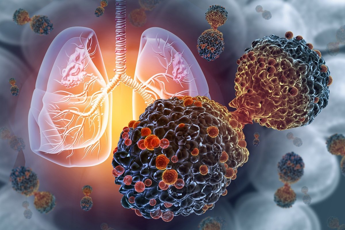 Como funciona 1ª vacina do mundo para prevenção do câncer de pulmão