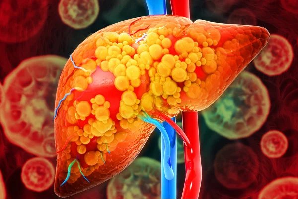 Gordura no fígado: saiba sinais que exigem atenção e como se prevenir
