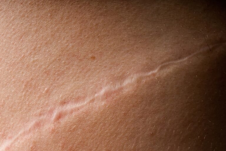 proteína ligada ao câncer ajuda a cicatrizar feridas na pele