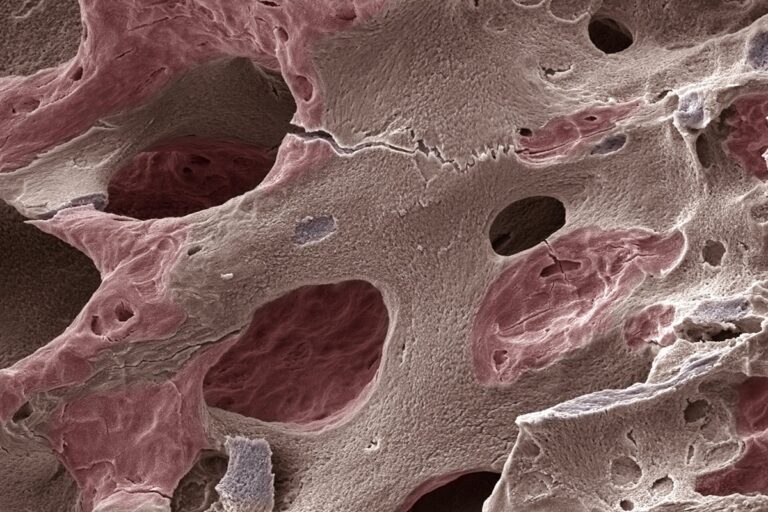 Ortopedista e fisiatra listam os principais sintomas da osteoporose