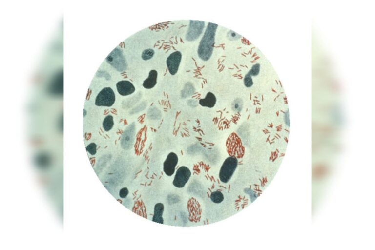 Brasil registra 22 mil casos ao ano de hanseníase. Conheça a doença