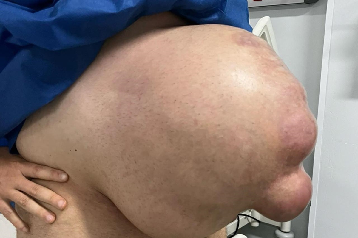 Com hérnia abdominal, homem fica com barriga enorme: "Cresceu em 1 mês"