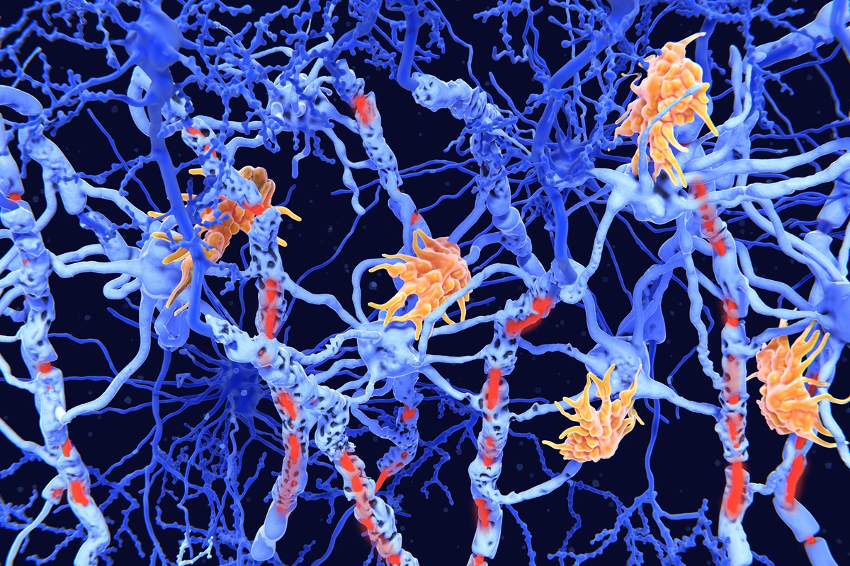 Estudo identifica 2 novos tipos de esclerose múltipla com ajuda da IA